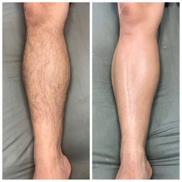 homem-depilacao-luz-pulsada-perna-toda